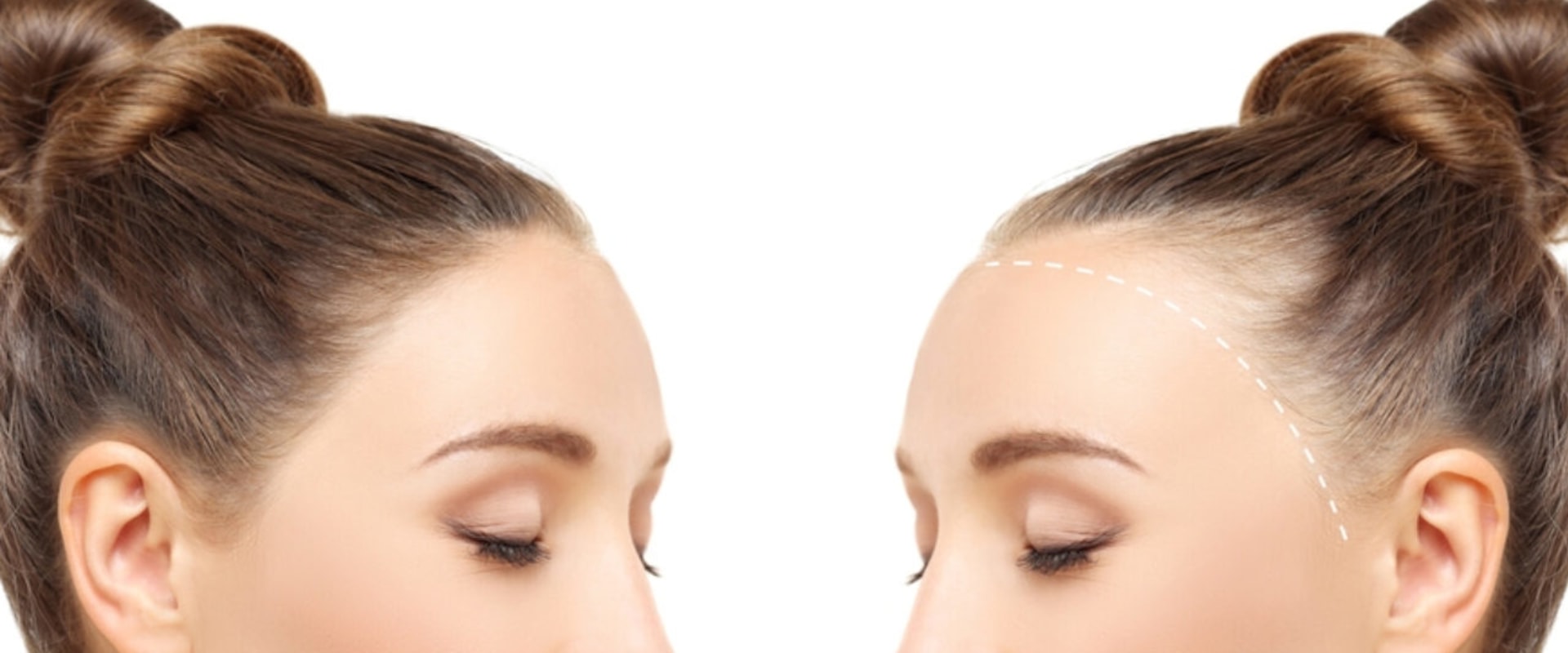 Hormonal Changes and Female Hair Loss: Understanding the Connection